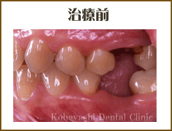 インプラント施術例 治療前